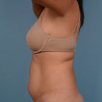 Liposuction Before & After Patient #690