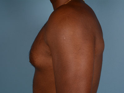 Gynecomastia Before & After Patient #2519