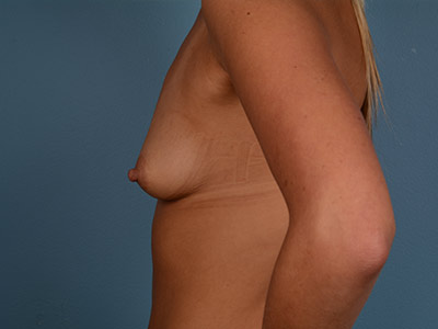 Breast Augmentation Before & After Patient #2568