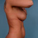 Vaser Liposuction Before & After Patient #746