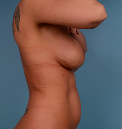 Vaser Liposuction Before & After Patient #746