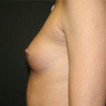 Breast Augmentation Before & After Patient #2733