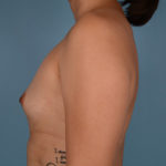 Breast Augmentation Before & After Patient #2937