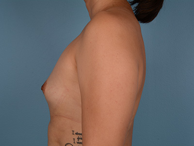 Breast Augmentation Before & After Patient #2937