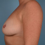 Breast Augmentation Before & After Patient #2965