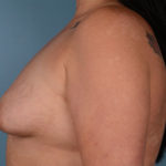Breast Augmentation Before & After Patient #3083
