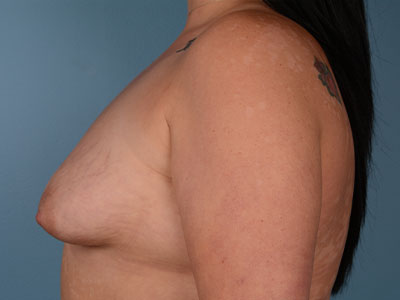 Breast Augmentation Before & After Patient #3083