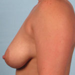 Breast Lift with Augmentation Before & After Patient #3171