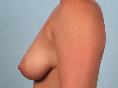 Breast Lift Before & After Patient #3171