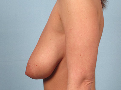 Breast Lift Before & After Patient #3178