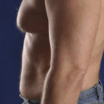Male Liposuction Before & After Patient #914