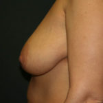 Breast Lift with Augmentation Before & After Patient #3232