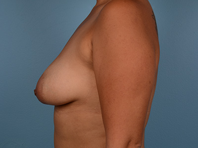 Breast Lift with Augmentation Before & After Patient #3289
