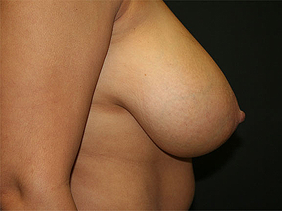 Breast Reduction Before & After Patient #3436