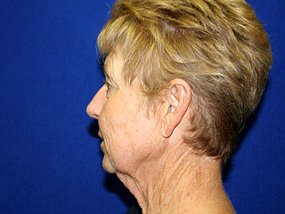 Face & Neck Lift Before & After Patient #4166