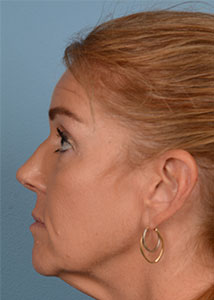 Face & Neck Lift Before & After Patient #4173