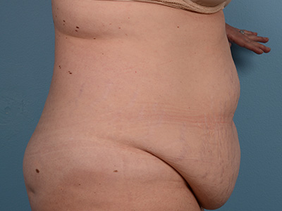 Tummy Tuck Before & After Patient #1230