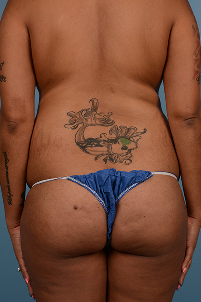 Brazilian Butt Lift Before & After Patient #581