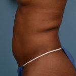 CoolSculpting Before & After Patient #1430