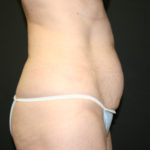 Tummy Tuck Before & After Patient #1484