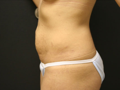 Tummy Tuck Before & After Patient #1570