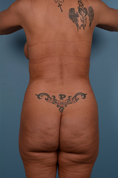 Brazilian Butt Lift Before & After Patient #606