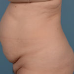 Tummy Tuck Before & After Patient #1707