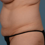 Tummy Tuck Before & After Patient #1728