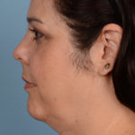 Face & Neck Liposuction Before & After Patient #1884