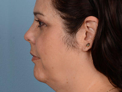 Neck (Submental) Liposuction Before & After Patient #1884