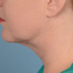 Neck (Submental) Liposuction Before & After Patient #1959