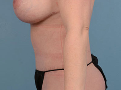 Tummy Tuck Before & After Patient #2092
