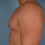 Gynecomastia Before & After Patient #2457