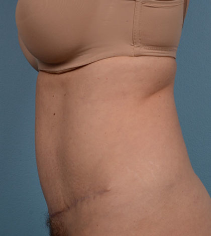 Vaser Liposuction Before & After Patient #877