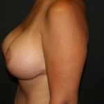 Breast Lift with Augmentation Before & After Patient #3232