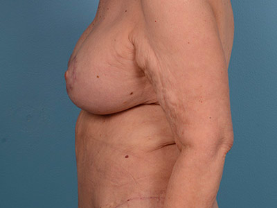 Breast Lift with Augmentation Before & After Patient #3271
