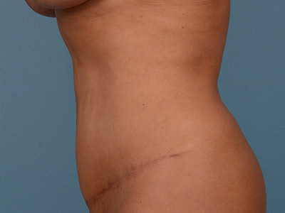 Mini Tummy Tuck Before & After Patient #948