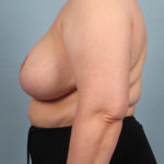 Breast Reduction Before & After Patient #3406