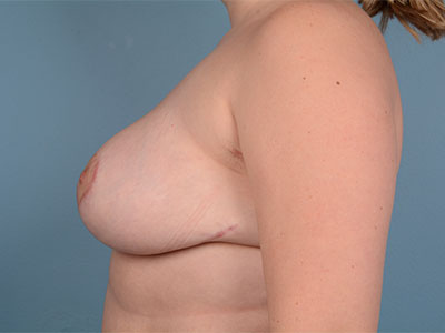 Breast Reduction Before & After Patient #3455