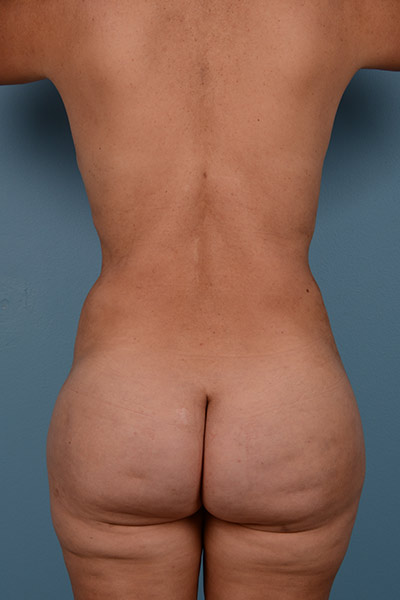 Brazilian Butt Lift Before & After Patient #555