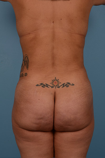 Brazilian Butt Lift (BBL) Before & After Patient #568