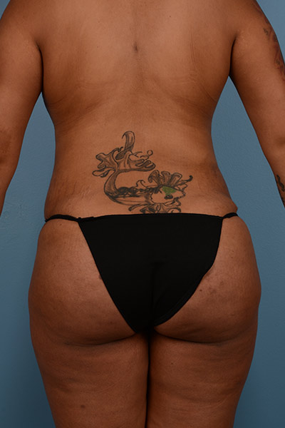 Brazilian Butt Lift Before & After Patient #581