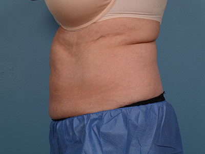 CoolSculpting Before & After Patient #1402