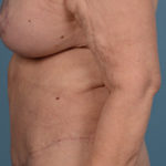 Tummy Tuck Before & After Patient #1421