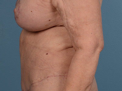 Tummy Tuck Before & After Patient #1421