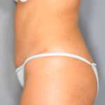 Tummy Tuck Before & After Patient #1449