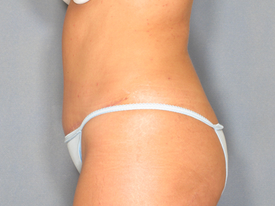 Tummy Tuck Before & After Patient #1449