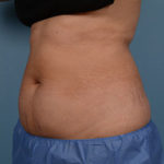 CoolSculpting Before & After Patient #1450