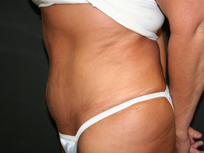 Tummy Tuck Before & After Patient #1531