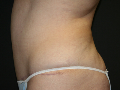 Tummy Tuck Before & After Patient #1613